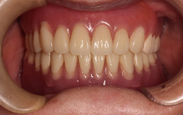 アタッチメント義歯/インプラント義歯