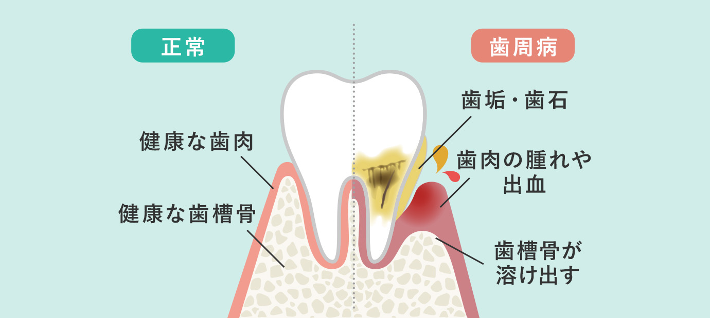 正常：健康な歯肉、健康な歯槽骨。歯周病：歯垢、歯石、歯肉の腫れや出血、歯槽骨が溶け出す