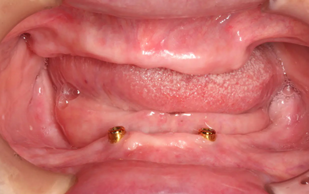 アタッチメント義歯/インプラント義歯