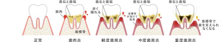 正常、歯肉炎、軽度歯周炎、中度歯周炎、重度歯周炎